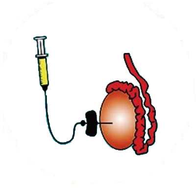 TESA Medical Illustration
